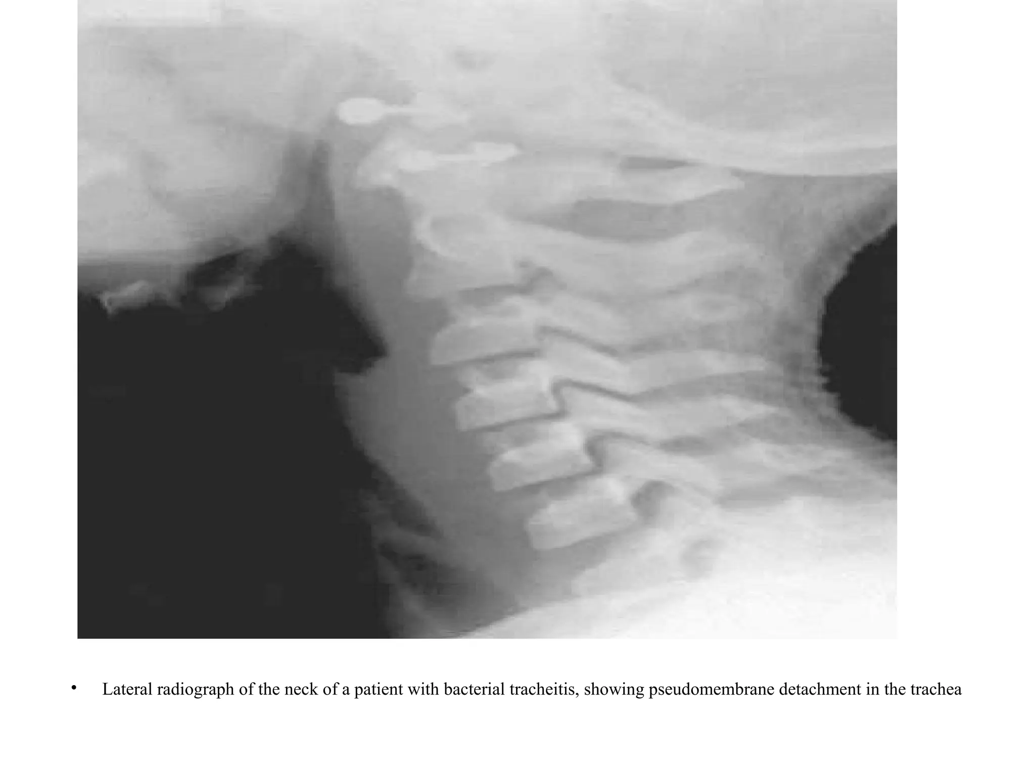 Traqueitis Rx Bacterial Tracheitis Dr Herow.pptx document | PPTX