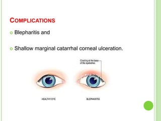 COMPLICATIONS
 Blepharitis and
 Shallow marginal catarrhal corneal ulceration.
 