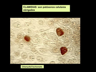 CLAMIDIAS: son patóxenos celulares
obrigados

ChlamydiaTrachomatis

 
