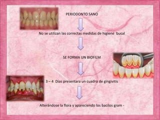 PERIODONTO SANO
No se utilizan las correctas medidas de higiene bucal
SE FORMA UN BIOFILM
3 – 4 Días presentara un cuadro de gingivitis
Alterándose la flora y apareciendo los bacilos gram -
 