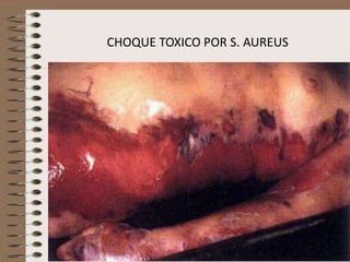 CHOQUE TOXICO POR S. AUREUS
 
