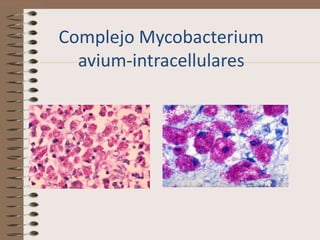 Complejo Mycobacterium
  avium-intracellulares
 