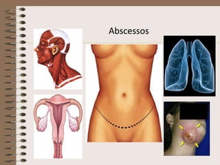 Abscessos
 