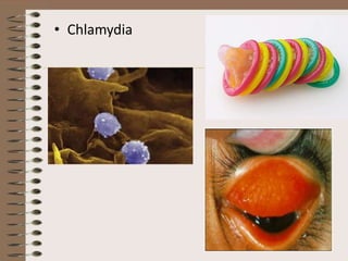 • Chlamydia
 