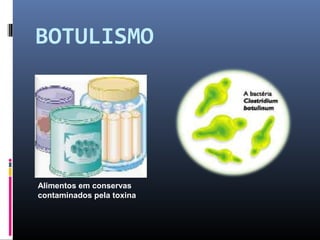 BOTULISMO 
Alimentos em conservas 
contaminados pela toxina 
 