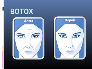 BOTOX 
 