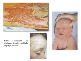 Forma localizada da
síndrome da pele escaldada:
impetigo bolhoso
 