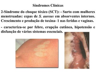 Síndromes Clínicas
2-Síndrome do choque tóxico (SCT): - Surto com mulheres
menstruadas: cepas de S. aureus em absorventes internos.
Crescimento e produção de toxina- 1 nas feridas e vaginas.
- caracteriza-se por febre, erupção cutânea, hipotensão e
disfunção de vários sistemas essenciais.
 