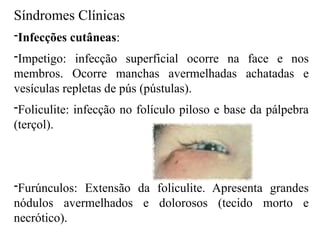 Síndromes Clínicas
-Infecções cutâneas:
-Impetigo: infecção superficial ocorre na face e nos
membros. Ocorre manchas avermelhadas achatadas e
vesículas repletas de pús (pústulas).
-Foliculite: infecção no folículo piloso e base da pálpebra
(terçol).
-Furúnculos: Extensão da foliculite. Apresenta grandes
nódulos avermelhados e dolorosos (tecido morto e
necrótico).
 