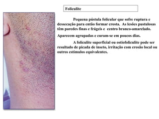 Pequena pústula folicular que sofre ruptura e
dessecação para então formar crosta. As lesões pustulosas
têm paredes finas e frágeis e centro branco-amarelado.
Aparecem agrupadas e curam-se em poucos dias.
A foliculite superficial ou ostiofoliculite pode ser
resultado de picada de inseto, irritação com erosão local ou
outros estímulos equivalentes.
Foliculite
 