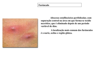 Abscesso estafilocócico perifolicular, com
supuração central na área em que forma-se tecido
necrótico, que é eliminado depois de um período
variável de dias.
A localização mais comum dos furúnculos
é o nariz, axilas e região glútea.
Furúnculo
 