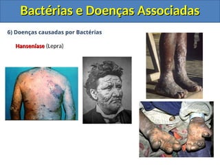 6) Doenças causadas por Bactérias
Hanseníase
Hanseníase (Lepra)
Bactérias e Doenças Associadas
Bactérias e Doenças Associadas
 