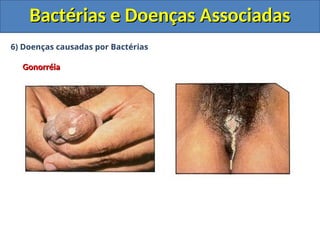 6) Doenças causadas por Bactérias
Gonorréia
Gonorréia
Bactérias e Doenças Associadas
Bactérias e Doenças Associadas
 