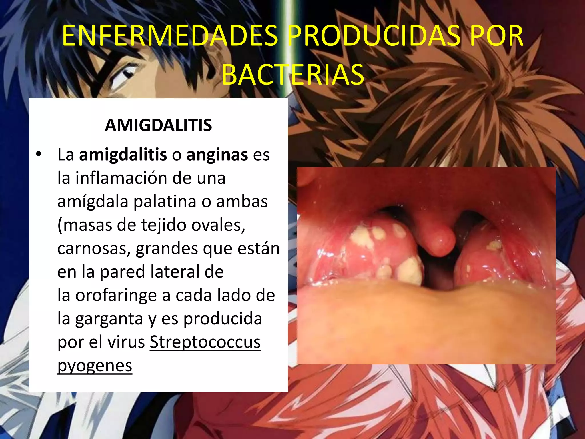 ENFERMEDADES PRODUCIDAS POR BACTERIAS AMIGDALITISLa amigdalitis o anginas es la inflamación de una amígdala palatina o ambas (masas de tejido ovales, carnosas, grandes que están en la pared lateral de la orofaringe a cada lado de la garganta y es producida por el virus Streptococcuspyogenes