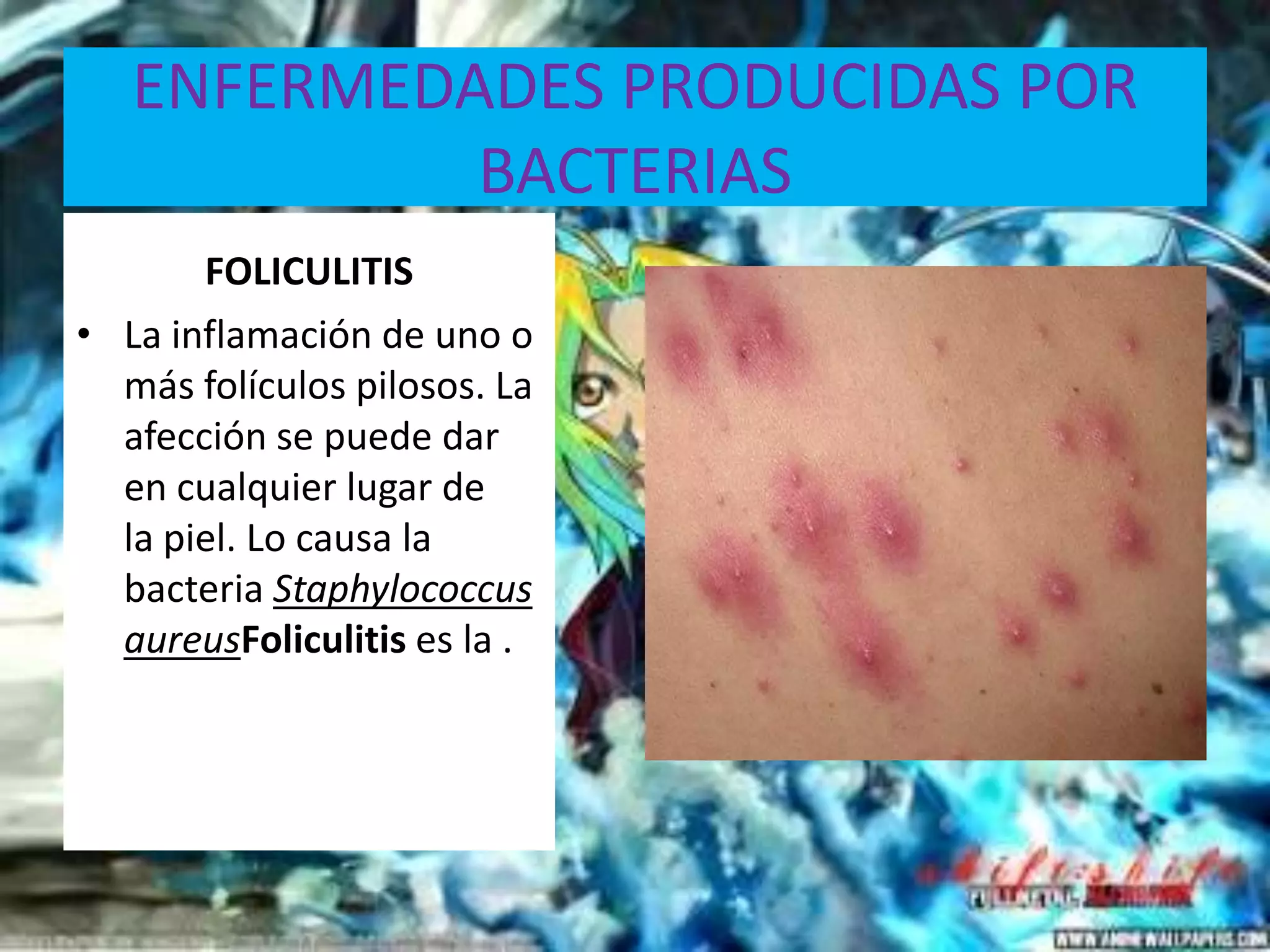 ENFERMEDADES PRODUCIDAS POR BACTERIASFOLICULITISLa inflamación de uno o más folículos pilosos. La afección se puede dar en cualquier lugar de la piel. Lo causa la bacteria StaphylococcusaureusFoliculitis es la .