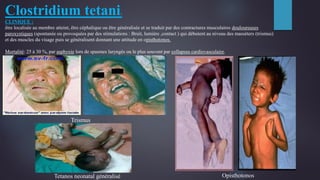 Clostridium tetani:
CLINIQUE :
être localisée au membre atteint, être céphalique ou être généralisée et se traduit par des contractures musculaires douloureuses
paroxystiques (spontanée ou provoquées par des stimulations : Bruit, lumière ,contact ) qui débutent au niveau des masséters (trismus)
et des muscles du visage puis se généralisent donnant une attitude en opisthotonos.
Mortalité: 25 à 30 %, par asphyxie lors de spasmes laryngés ou le plus souvent par collapsus cardiovasculaire.
Trismus
OpisthotonosTetanos neonatal généralisé
 