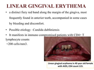 LINEAR GINGIVAL ERYTHEMA
• a distinct fiery red band along the margin of the gingiva, most
frequently found in anterior teeth, accompanied in some cases
by bleeding and discomfort.
• Possible etiology –Candida dubliniensis
• It manifests in immuno compromised patients with CD4+ T
lymphocyte counts
<200 cells/mm3.
Linear gingival erythema in 49 year old female
with AIDS, CD4 count 115.
 
