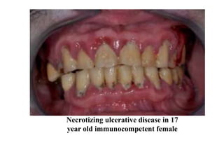 Necrotizing ulcerative disease in 17
year old immunocompetent female
 