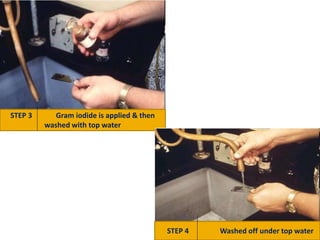 STEP 3 Gram iodide is applied & then
washed with top water
STEP 4 Washed off under top water
 