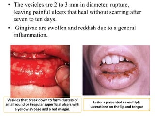 • The vesicles are 2 to 3 mm in diameter, rupture,
leaving painful ulcers that heal without scarring after
seven to ten days.
• Gingivae are swollen and reddish due to a general
inflammation.
Vesicles that break down to form clusters of
small round or irregular superficial ulcers with
a yellowish base and a red margin.
Lesions presented as multiple
ulcerations on the lip and tongue
 