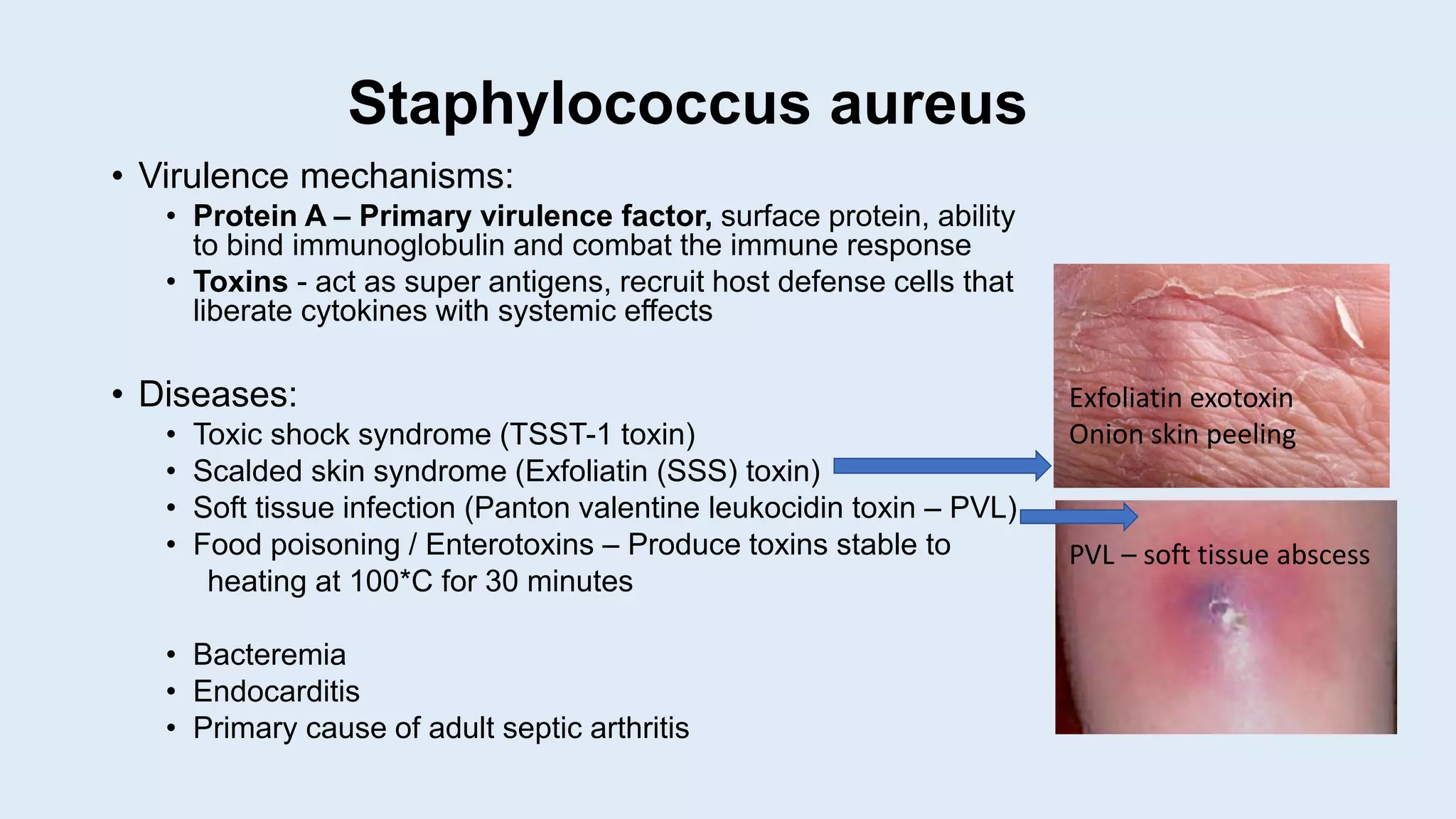 Staphylococcus aureus
• Virulence mechanisms:
• Protein A – Primary virulence factor, surface protein, ability
to bind immunoglobulin and combat the immune response
• Toxins - act as super antigens, recruit host defense cells that
liberate cytokines with systemic effects
• Diseases:
• Toxic shock syndrome (TSST-1 toxin)
• Scalded skin syndrome (Exfoliatin (SSS) toxin)
• Soft tissue infection (Panton valentine leukocidin toxin – PVL)
• Food poisoning / Enterotoxins – Produce toxins stable to
heating at 100*C for 30 minutes
• Bacteremia
• Endocarditis
• Primary cause of adult septic arthritis
Exfoliatin exotoxin
Onion skin peeling
PVL – soft tissue abscess
 