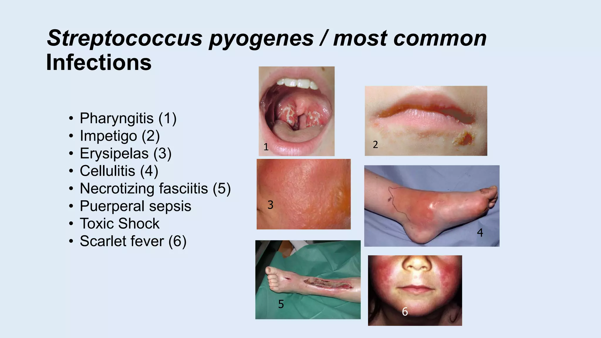 Streptococcus pyogenes / most common
Infections
• Pharyngitis (1)
• Impetigo (2)
• Erysipelas (3)
• Cellulitis (4)
• Necrotizing fasciitis (5)
• Puerperal sepsis
• Toxic Shock
• Scarlet fever (6)
3
4
5
6
1 2
 