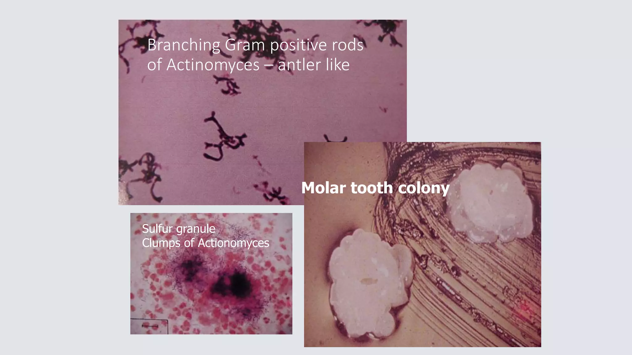 Branching Gram positive rods
of Actinomyces – antler like
Molar tooth colony
Sulfur granule
Clumps of Actionomyces
 
