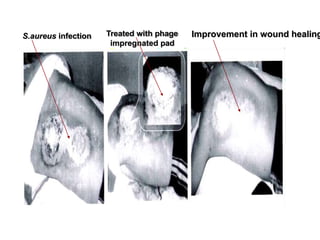 S.aureus infection Treated with phage
impregnated pad
Improvement in wound healing
 
