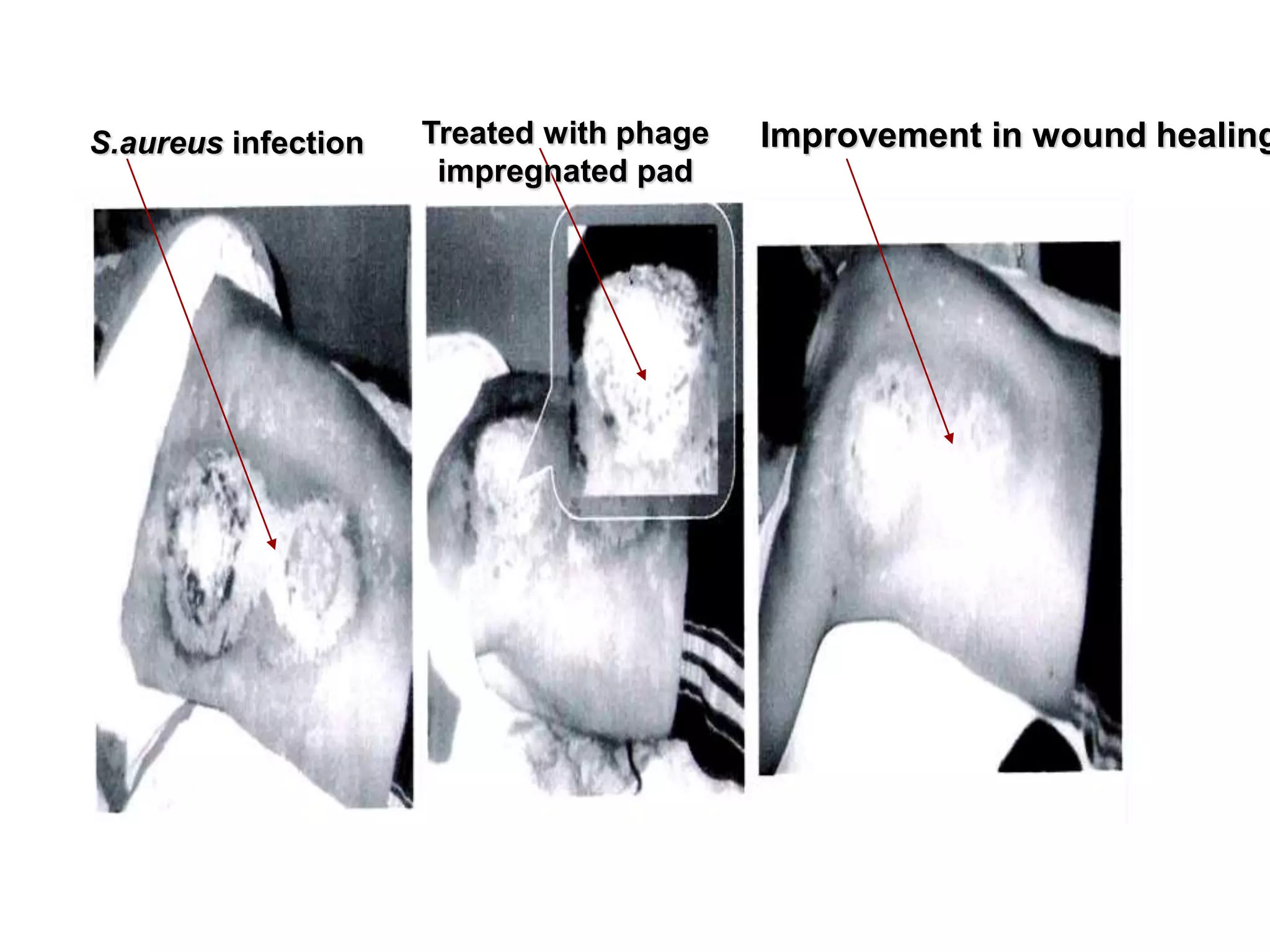 S.aureus infection Treated with phage
impregnated pad
Improvement in wound healing
 