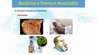 6) Doenças causadas por Bactérias
Tuberculose
Bactérias e Doenças Associadas
 