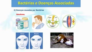 6) Doenças causadas por Bactérias
Botulismo
Bactérias e Doenças Associadas
 