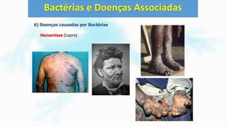 6) Doenças causadas por Bactérias
Hanseníase (Lepra)
Bactérias e Doenças Associadas
 