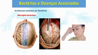 6) Doenças causadas por Bactérias
Meningite bacteriana
Bactérias e Doenças Associadas
 