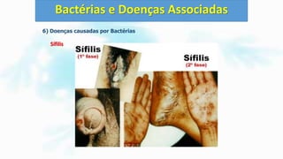 6) Doenças causadas por Bactérias
Sífilis
Bactérias e Doenças Associadas
 