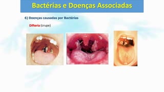 6) Doenças causadas por Bactérias
Difteria (crupe)
Bactérias e Doenças Associadas
 