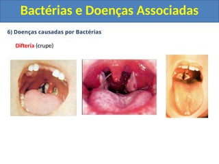 6) Doenças causadas por Bactérias
Difteria (crupe)
Bactérias e Doenças Associadas
 