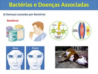 6) Doenças causadas por Bactérias
Botulismo
Bactérias e Doenças Associadas
 