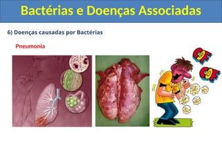 6) Doenças causadas por Bactérias
Pneumonia
Bactérias e Doenças Associadas
 