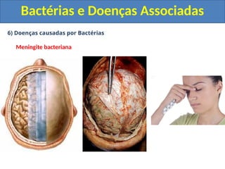 6) Doenças causadas por Bactérias
Meningite bacteriana
Bactérias e Doenças Associadas
 