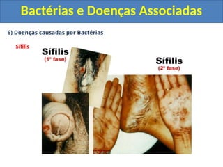 6) Doenças causadas por Bactérias
Sífilis
Bactérias e Doenças Associadas
 