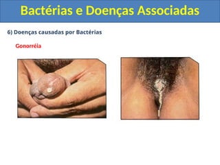 6) Doenças causadas por Bactérias
Gonorréia
Bactérias e Doenças Associadas
 