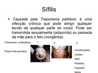 Sífilis
Tratamento: antibióticos
Possui três períodos:
1 2 3
Complicações
Lesões
SNC
Paralisia
Cegueira
 