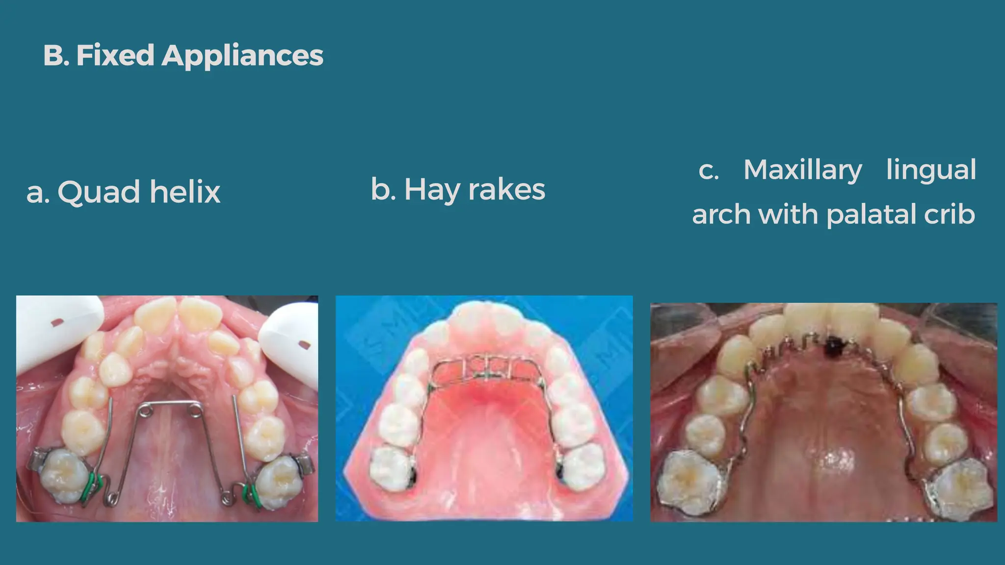 Bad oral habits in orthodontic..... pptx | PPTX