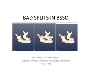 BAD SPLITS IN BSSO
DR JAMEEL KIFAYATULLAH
Lecturer Khyber College of dentistry Peshawar
PAKISTAN
 