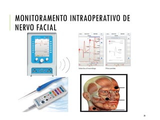 MONITORAMENTO INTRAOPERATIVO DE
NERVO FACIAL
38
 