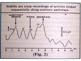 BAEP, BERA, BEP, Brainstem auditory evoked potential By Murtaza Syed | PPT