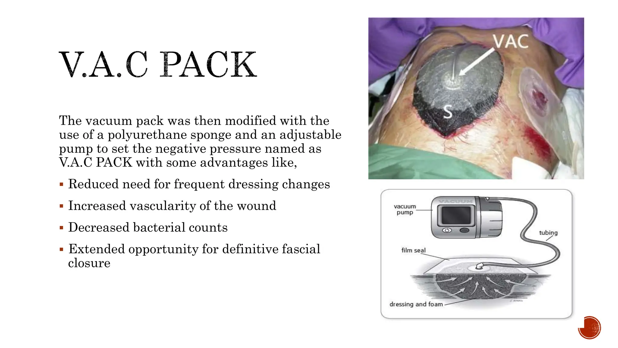 VARIOUS Temporary CLOSURE TECHNIQUES IN OPEN ABDOMEN.pptx
