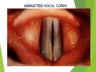 ADDUCTED VOCAL CORDS
 