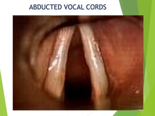 ABDUCTED VOCAL CORDS
 