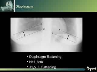 Loopografi Normal Radiologi Bahan Thorax Normal untuk radiologi pptx | PPTX